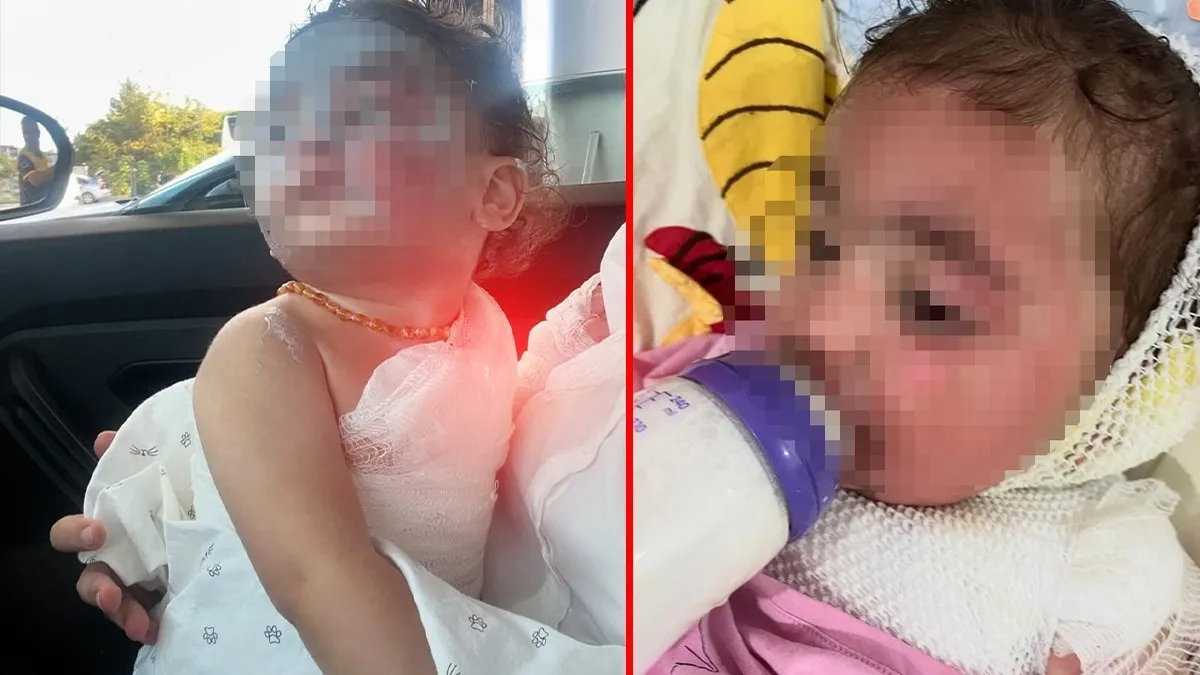 Anaokulunda üzerine kahve dökülen 1.5 yaşındaki Aden Aslan’da ikinci derece yanıklar oluştu! Kahrolan anne: “Benim evladım acı çekiyor”